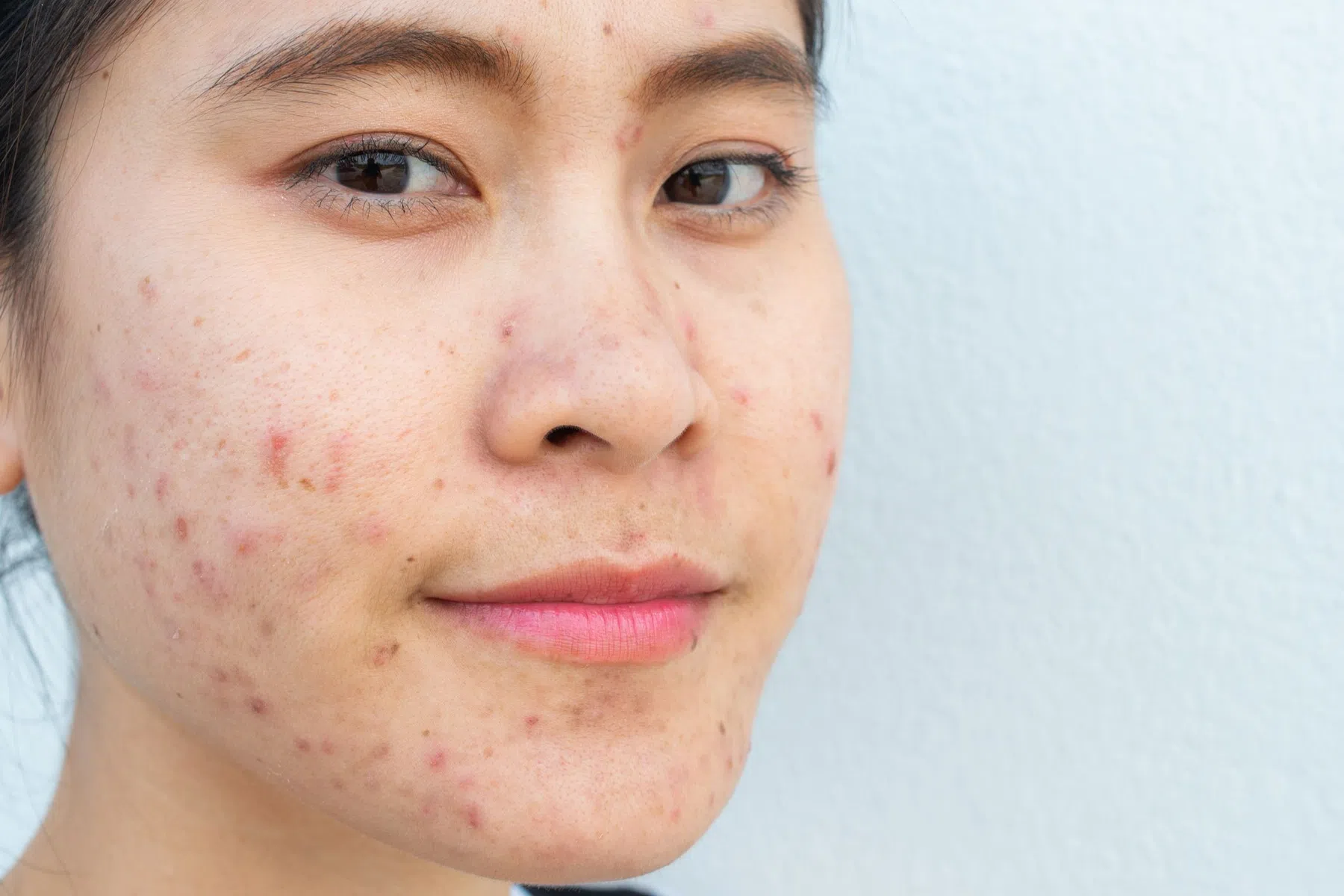 huid-acne-tips-puisten.jpg