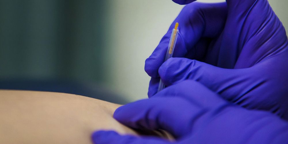 Dry-needling-wat-het-is-en-hoe-het-werkt.jpg